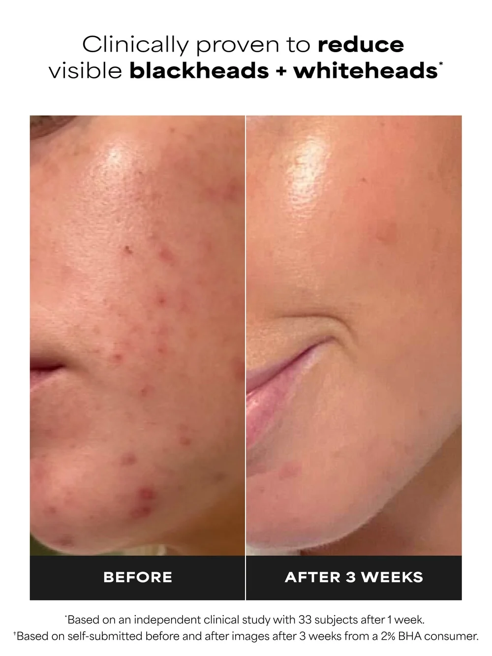 2% BHA Liquid Exfoliant - Image 2